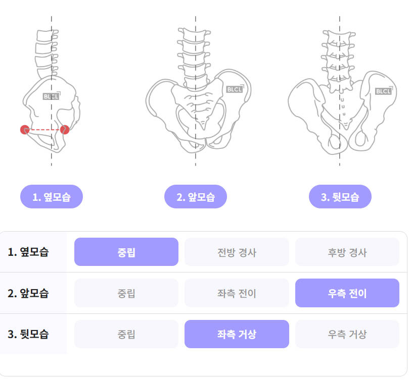 결과지의 좌우·앞뒤 골반 균형 항목